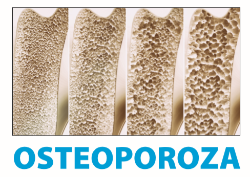 Napis Osteoporoza - rysunek zmienionych chorobowo kości